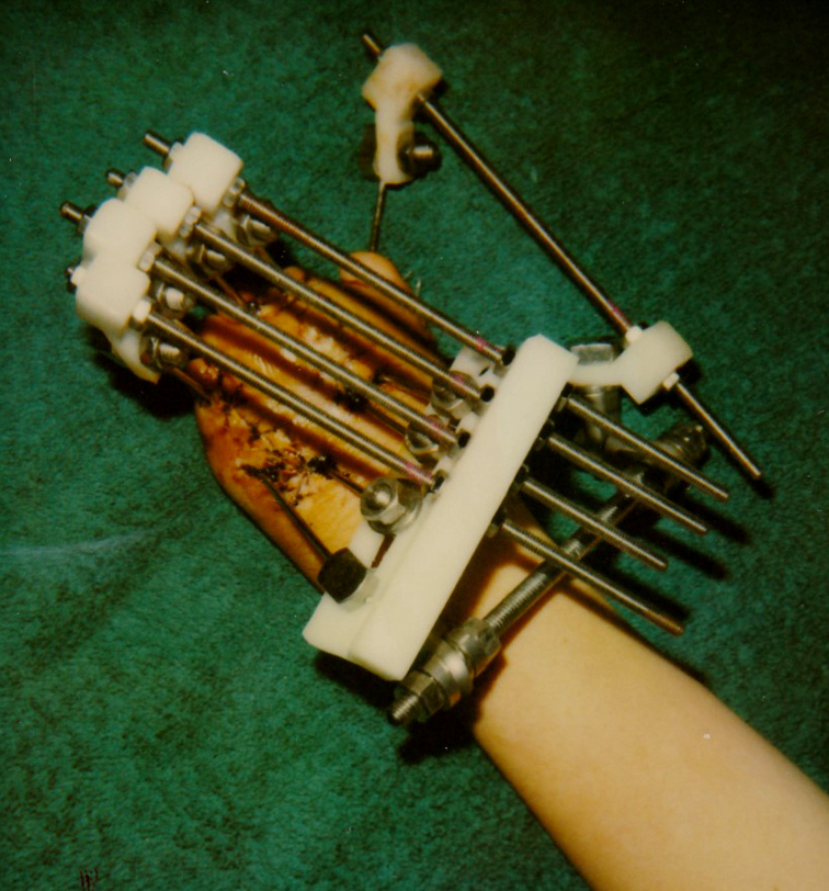 fixator